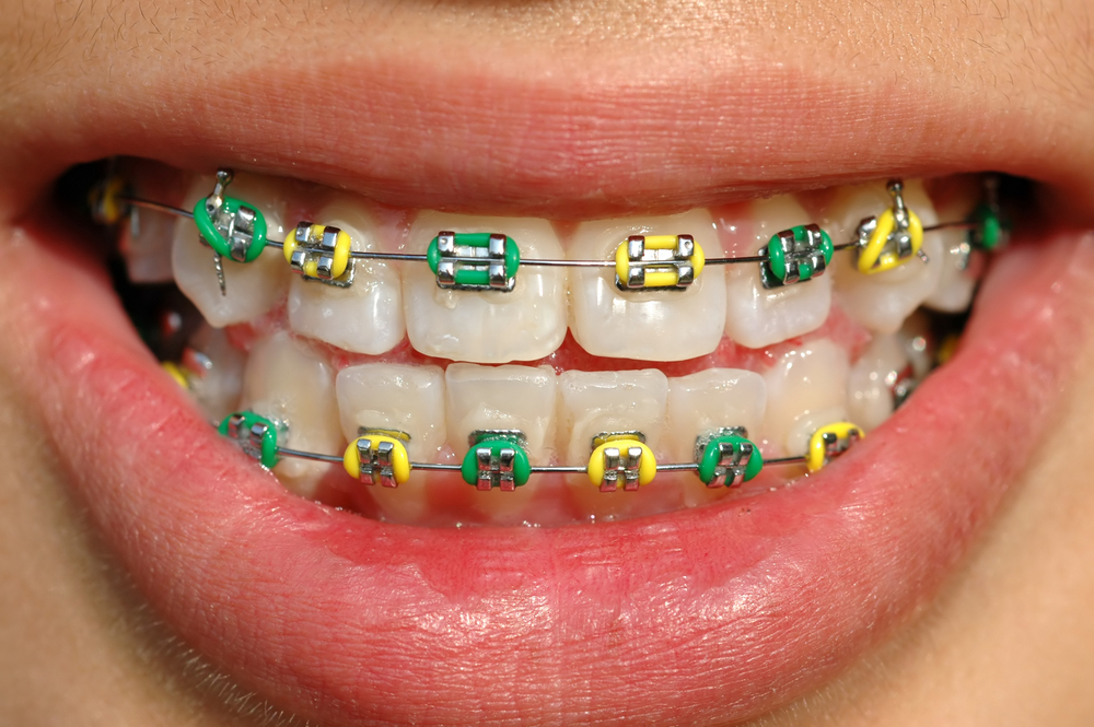 Dental braces