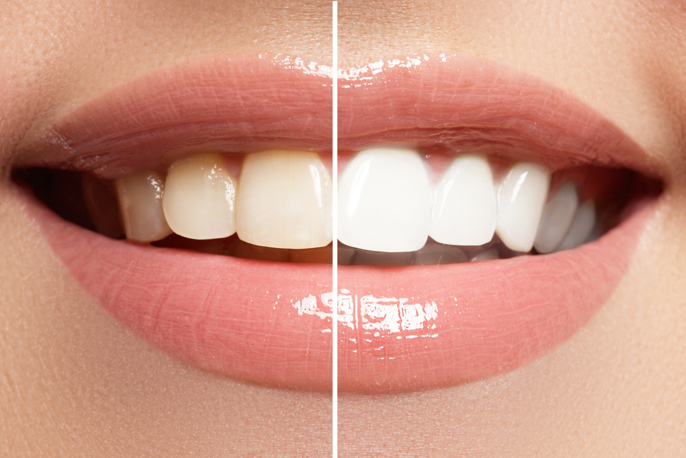 Teeth whitening Vashi