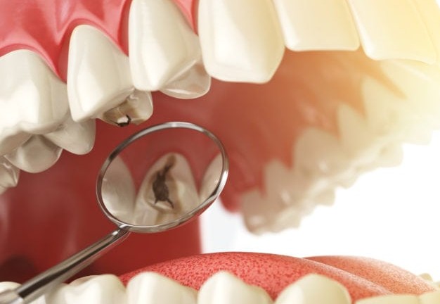 Cavities Causes