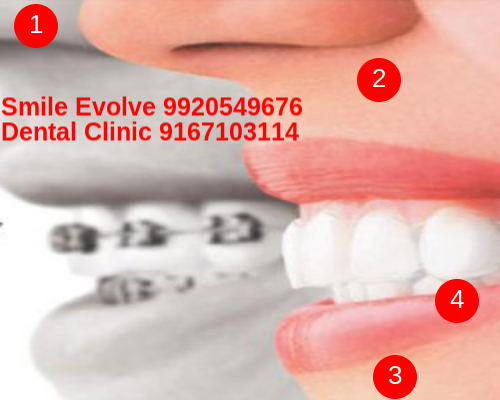 Invisalign smile