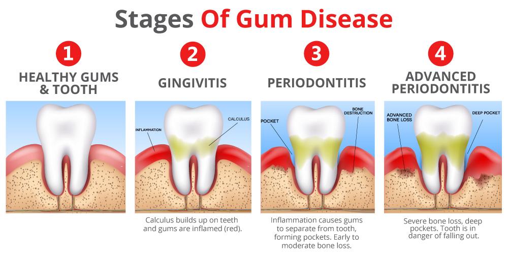 gum diseases