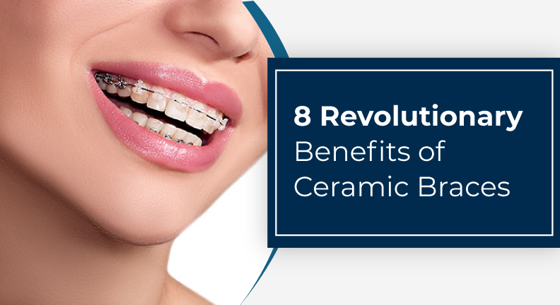 Benefits-of-Ceramic-Braces