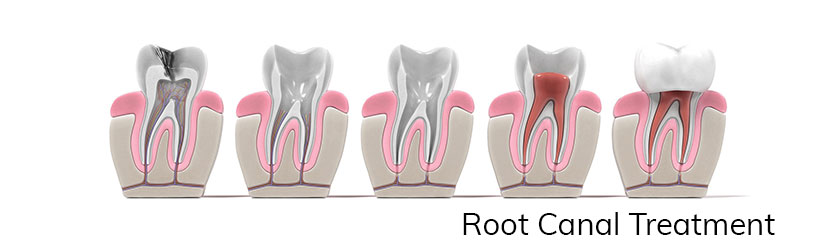 root canal treatment