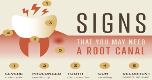 5-Common-Signs-You-May-Need-a-Root-Canal