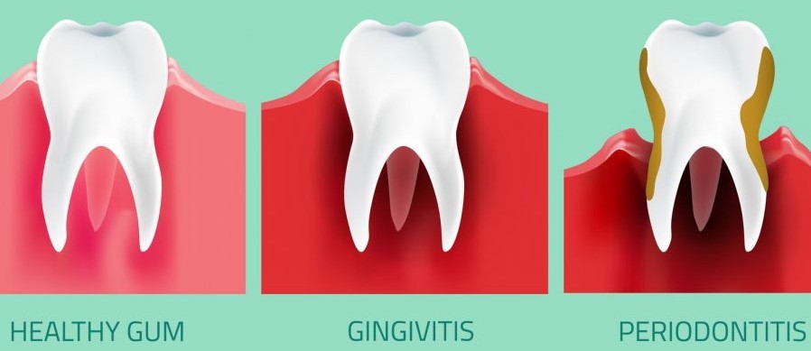 gum-diseases